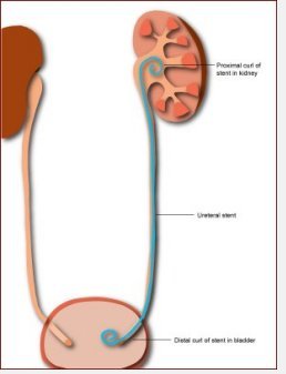 Ureteric Stents